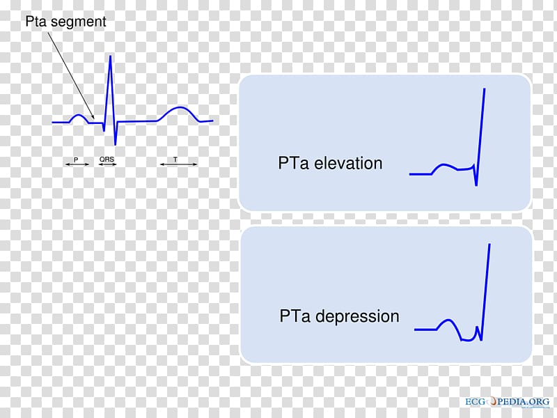 P wave Electrocardiogram Electrocardiography QRS complex Sinus rhythm, others transparent background PNG clipart