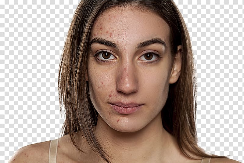 Scar Acne Dermatology Pimple Cutaneous condition, Scar transparent background PNG clipart