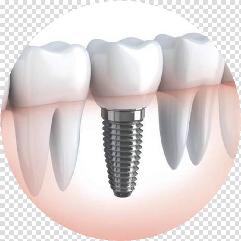 Dental implant Dentistry Dentures, crown transparent background PNG clipart