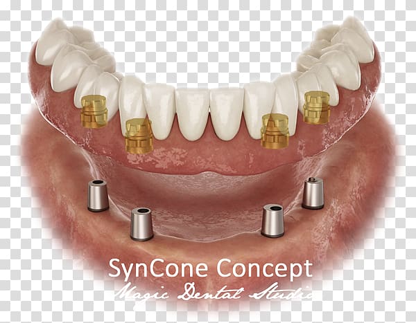 Dental implant Dentistry Dentures Prosthesis, others transparent background PNG clipart