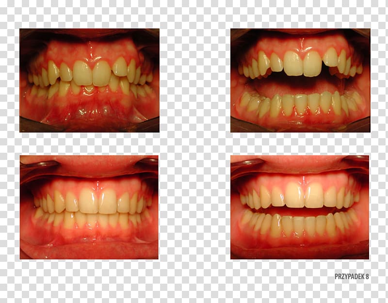 Tooth Camera Therapy Orthodontist Patient, others transparent background PNG clipart