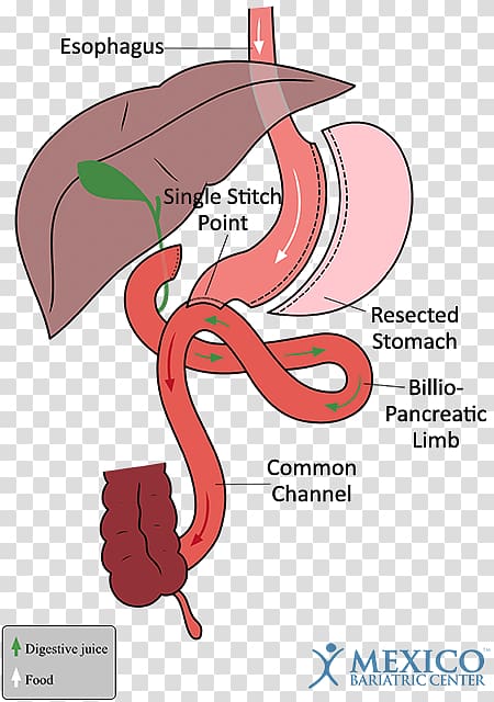 Duodenal switch Gastric bypass surgery Sleeve gastrectomy Bariatric surgery, others transparent background PNG clipart