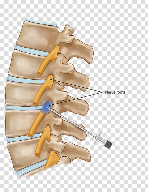 Nerve root Injection Vertebral column Nerve block, others transparent background PNG clipart