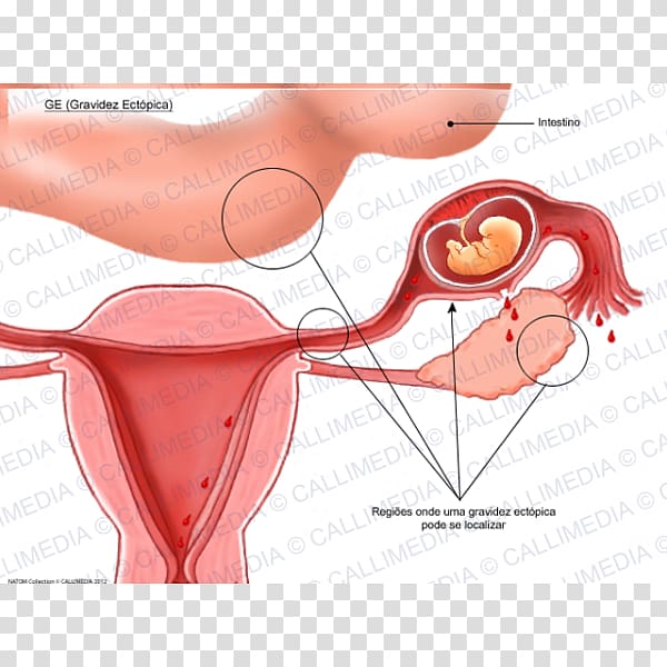 Ectopic pregnancy Uterus Gynaecology Symptom, pregnancy transparent background PNG clipart