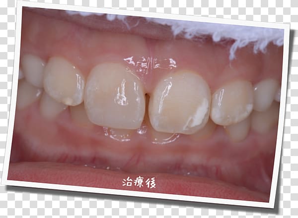 Tooth Gums Dental braces Dental Mouthguards Dentition, Dental Postcard transparent background PNG clipart