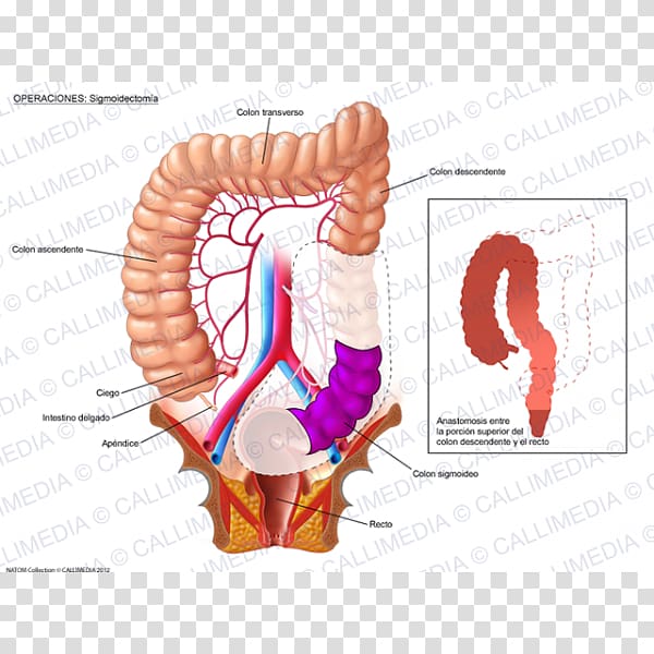 Colorectal cancer Surgery Colon Large intestine, descendant transparent background PNG clipart