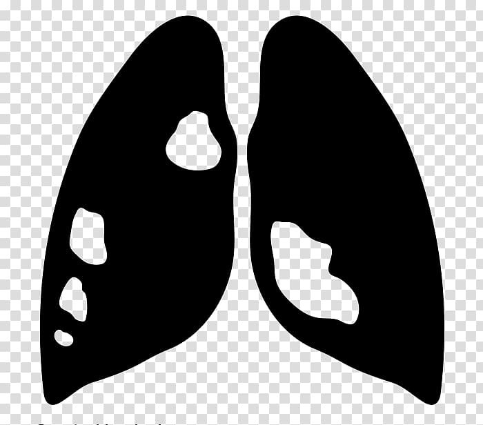 Lung cancer Lung cancer Computer Icons Respiratory disease, others transparent background PNG clipart