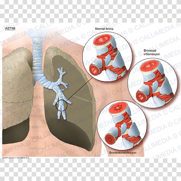 Asthma Lung Bronchus Respiratory tract, Asma transparent background PNG clipart