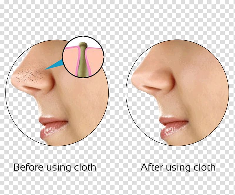 Comedo Skin Nose Exfoliation Pimple, nose transparent background PNG clipart
