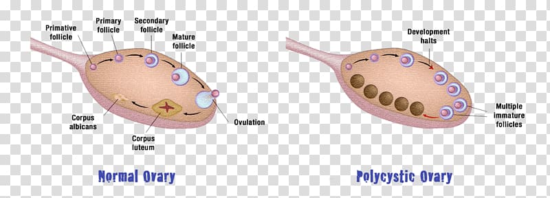 Polycystic ovary syndrome Ovarian cyst Ovarian disease, health transparent background PNG clipart