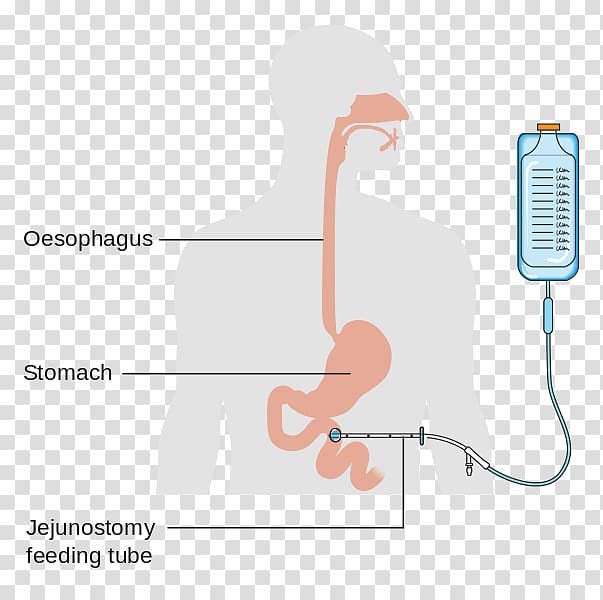 Jejunostomy Feeding tube Percutaneous endoscopic gastrostomy Nasogastric intubation, small intestine transparent background PNG clipart