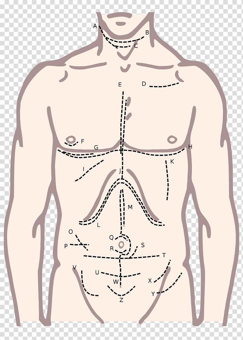 Surgical incision Surgery Xiphoid process McBurney's point Median sternotomy, others transparent background PNG clipart
