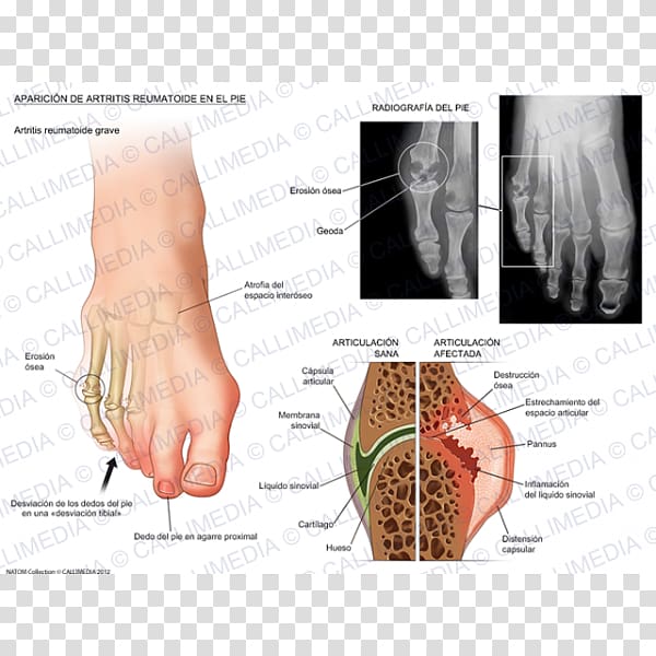 Rheumatoid arthritis Foot Thumb Rheumatology, others transparent background PNG clipart