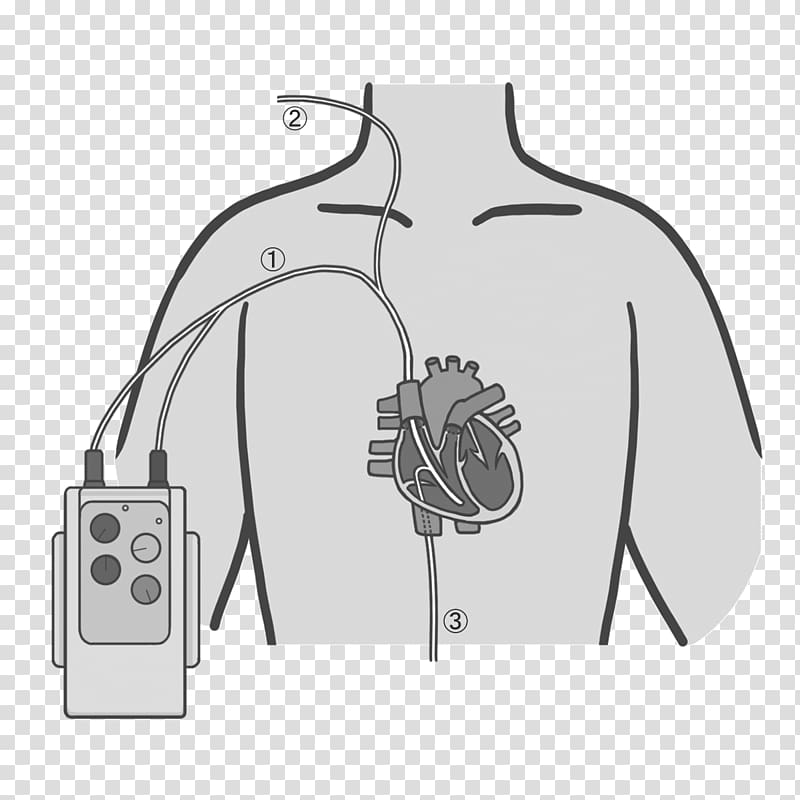 Artificial cardiac pacemaker Nursing Medical device Illustration Automated External Defibrillators, Extra Corporeal Septoplasty transparent background PNG clipart
