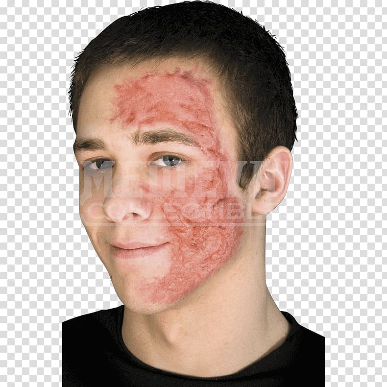 Burn scar contracture Wound Scarred, Scar transparent background PNG clipart