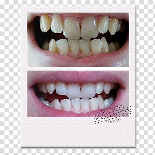 Tooth whitening Human tooth Dentist Oral hygiene, diy album transparent background PNG clipart