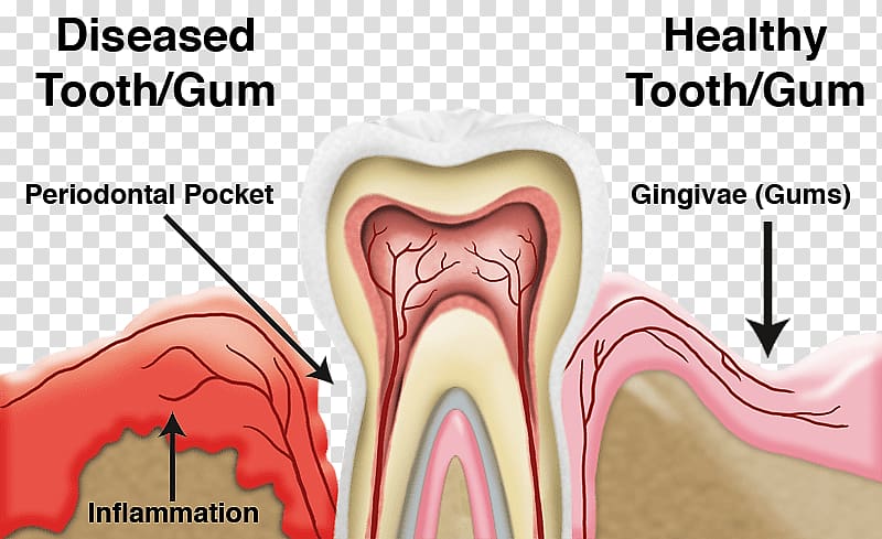 Periodontal disease Gums Periodontology Dentistry, Periodontal Disease transparent background PNG clipart