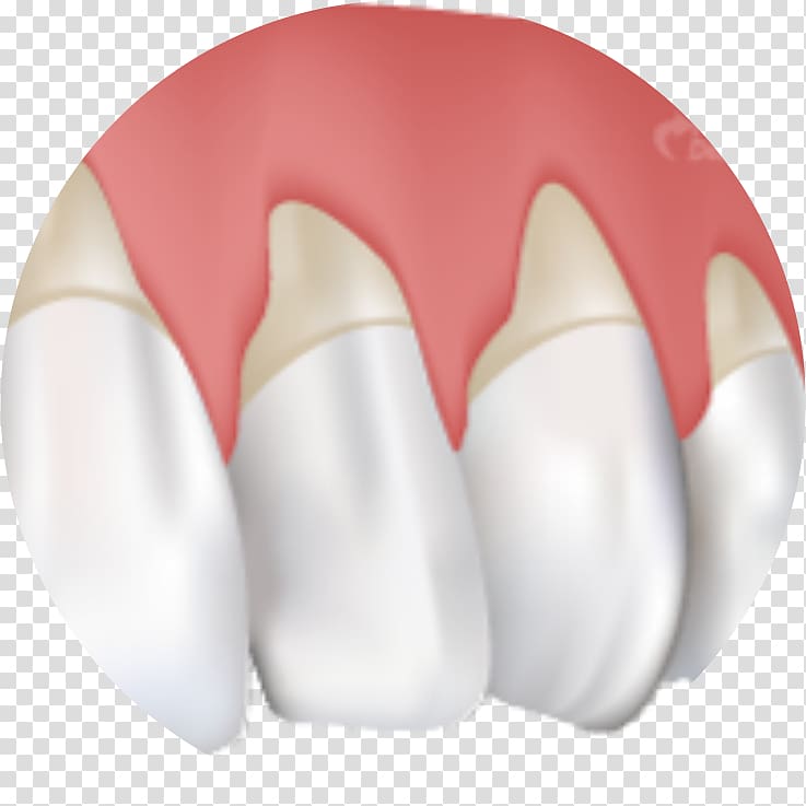 Gums Gingival recession Gingivitis Periodontal disease Cure, health transparent background PNG clipart