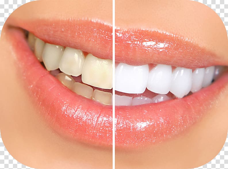 Tooth whitening Dentistry Human tooth, others transparent background PNG clipart