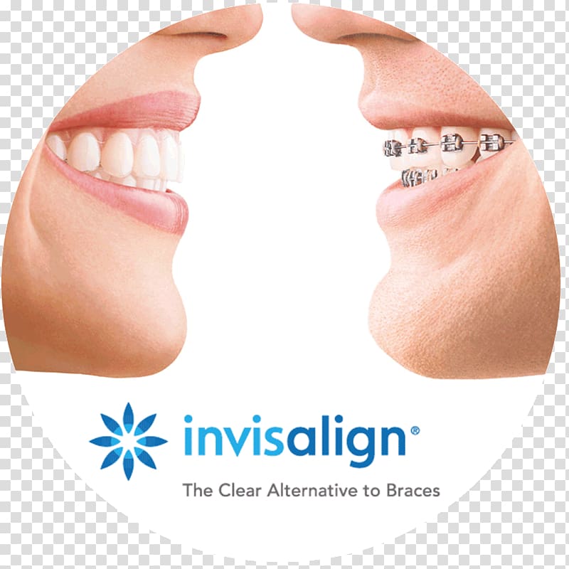 Clear aligners Dental braces Orthodontics Dentistry Retainer, invisalign transparent background PNG clipart