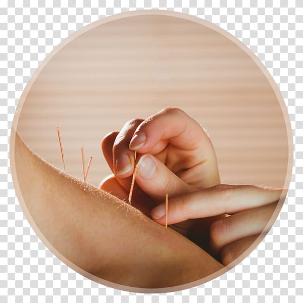 Dry needling Myofascial trigger point Acupuncture Myotherapy Myofascial release, Sunshine Coast Acupuncture Clinic Acupuncture Wit transparent background PNG clipart