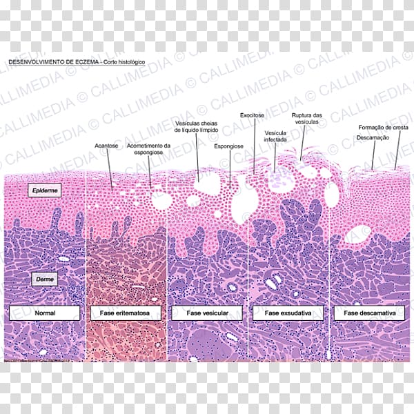 Histology Dermatitis Keratinocyte Microscope Slides Corte histológico, eqzema transparent background PNG clipart