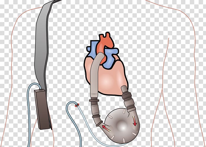 Ventricular assist device Heart transplantation Ventricle Heart failure, heart transparent background PNG clipart