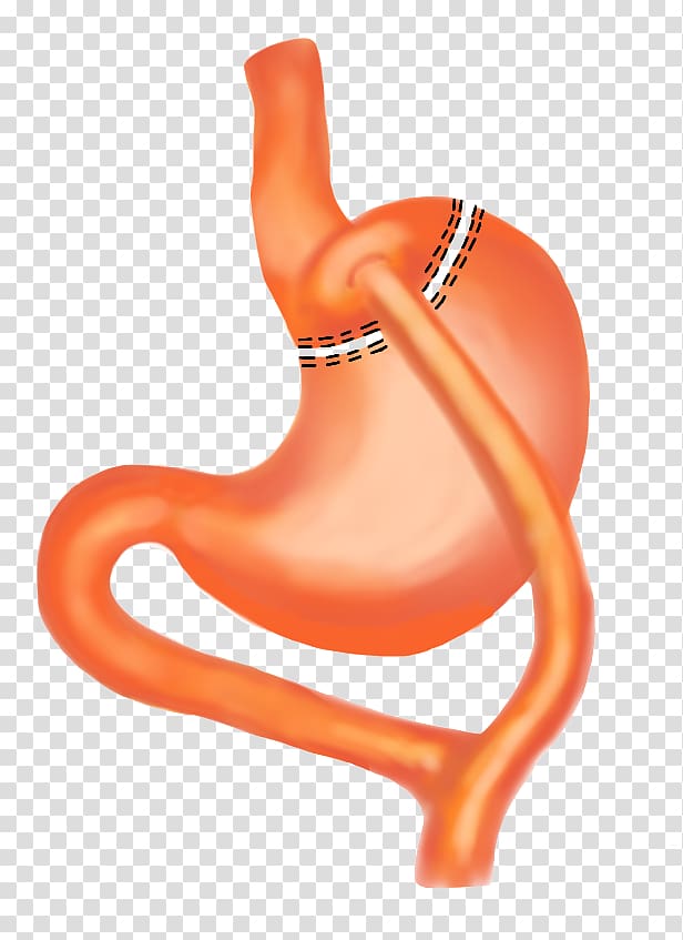 Stomach Bariatric surgery Body mass index Intervenție chirurgicală Health, stomach transparent background PNG clipart