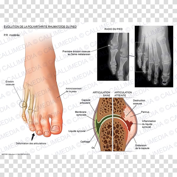 Rheumatoid arthritis Joint pain Rheumatology Joint stiffness, ráº¯n 3d transparent background PNG clipart