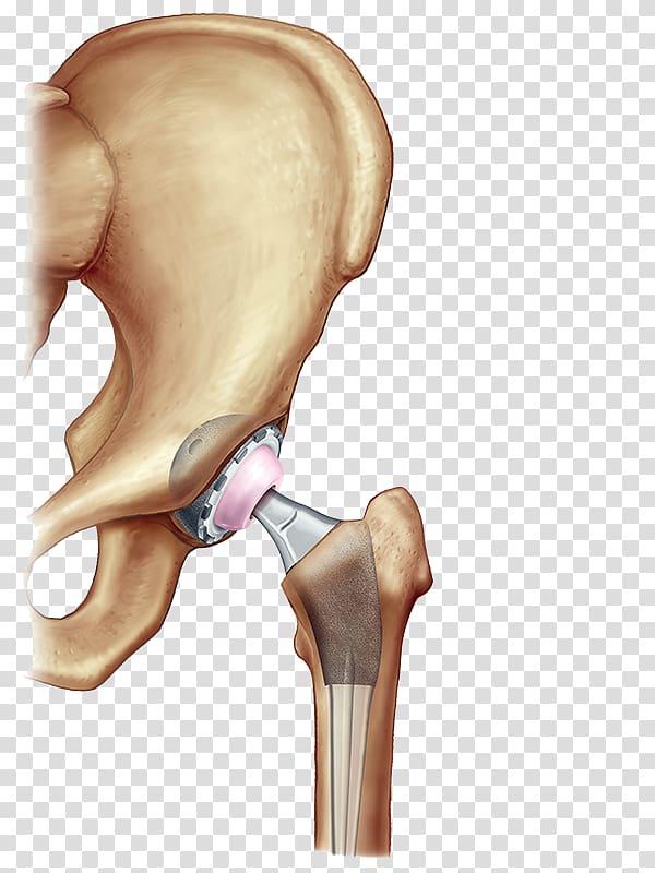 Hip replacement Surgery Knee replacement Joint replacement, Hip Arthroscopy transparent background PNG clipart