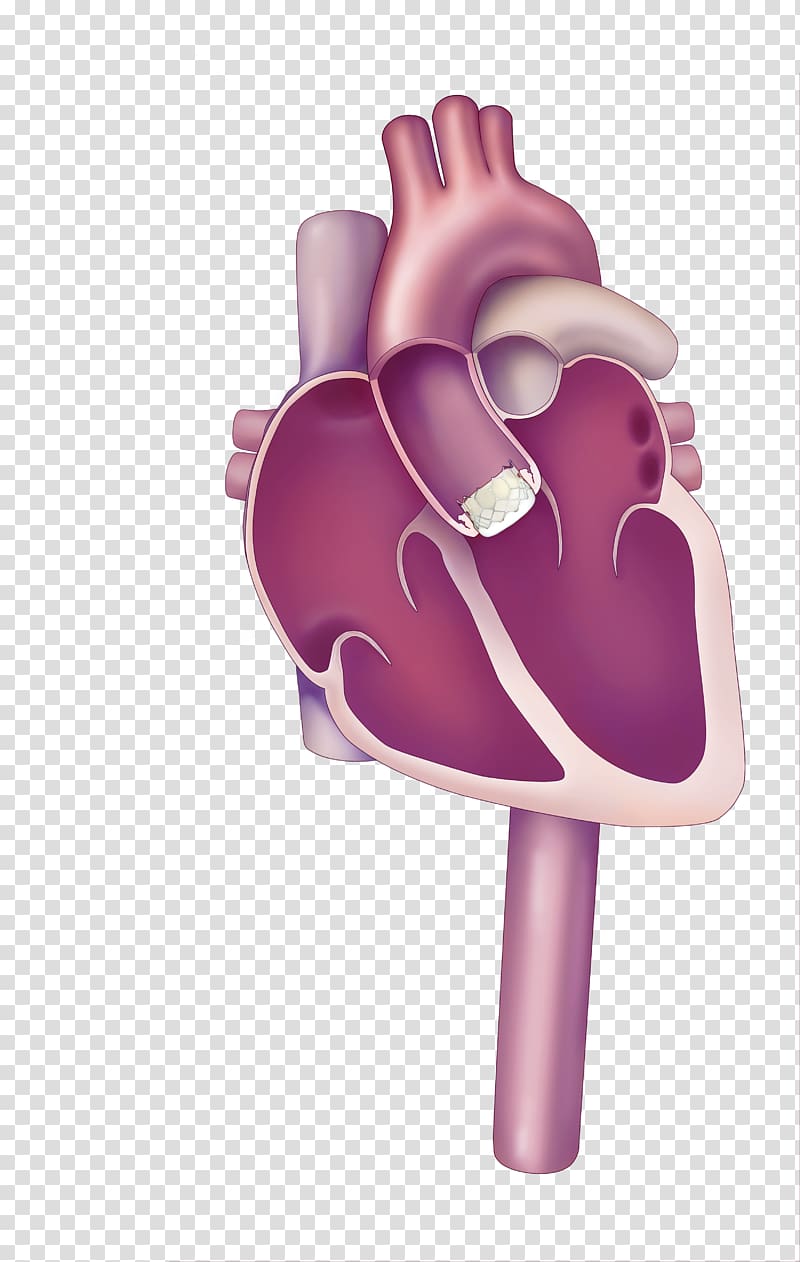 Percutaneous aortic valve replacement Valvular aortic stenosis Heart valve, heart transparent background PNG clipart