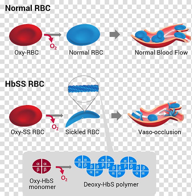 Sickle cell disease Hemoglobin Global Blood Therapeutics, sickle cell transparent background PNG clipart