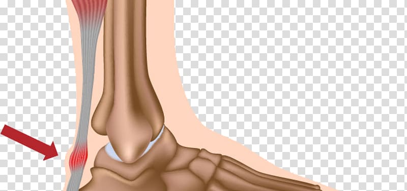 Achilles tendinitis Achilles tendon Tendinosis, tendon transparent background PNG clipart
