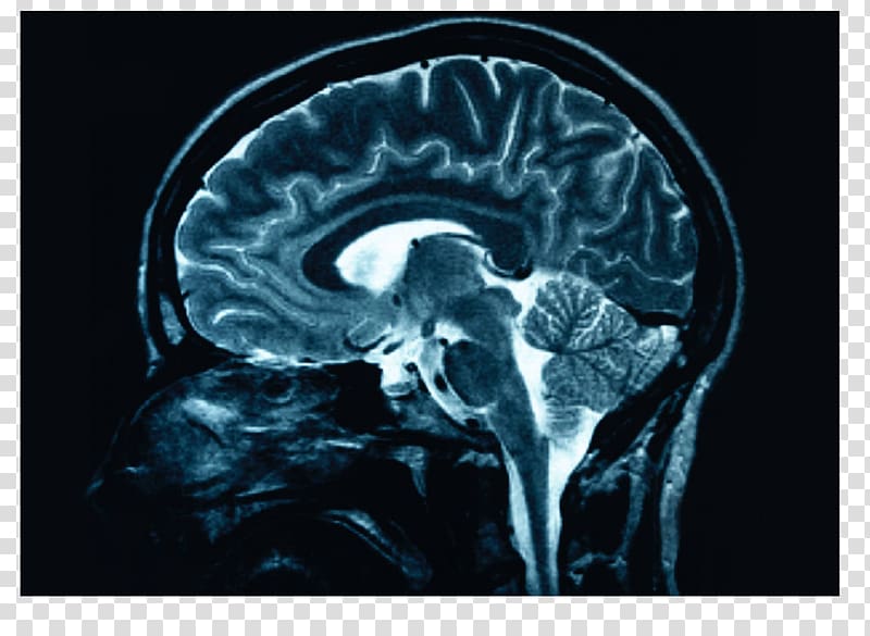 Human brain X-ray Head injury Medicine, Brain transparent background PNG clipart