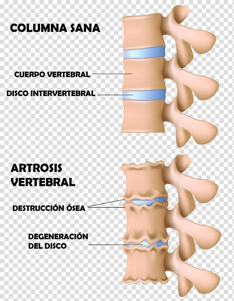 Vertebral column Osteophyte Osteoarthritis Bone Degenerative disc disease, cervical vertebra atlas transparent background PNG clipart