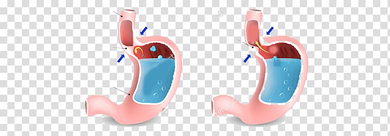 Gastroesophageal reflux disease Burning Chest Pain Stomach Esophagus, pregnancy transparent background PNG clipart