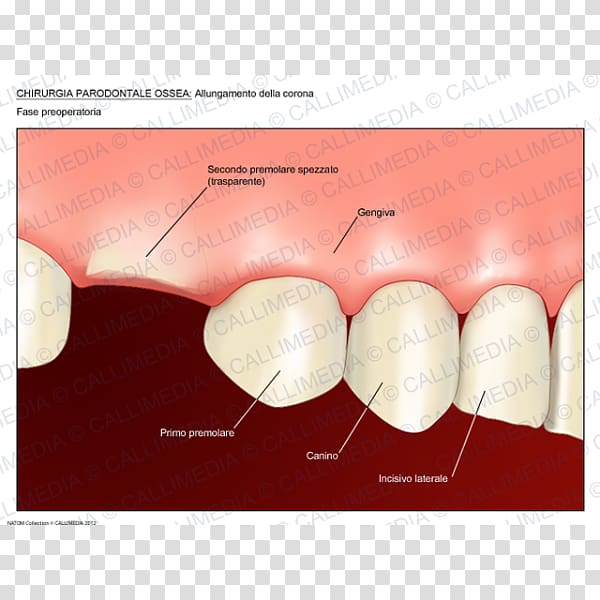 Surgery Crown lengthening Periodontal disease Periodontology Medicine, crown transparent background PNG clipart