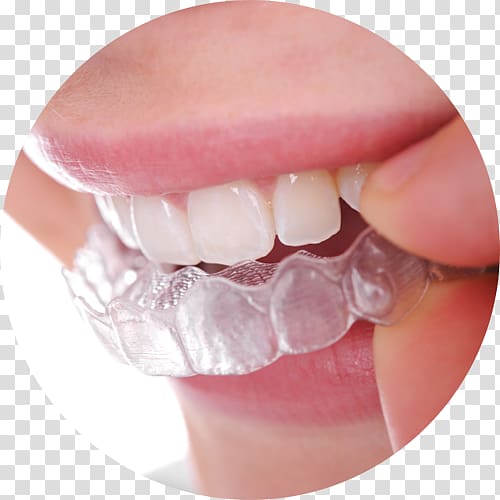 clear mouthpiece, Clear aligners Dental braces Dentistry Orthodontics Retainer, Dental Braces transparent background PNG clipart