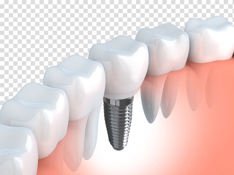 dental model transparent background PNG clipart