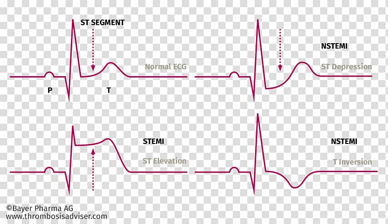 Acute coronary syndrome ST segment elevation myocardial infarction Angina pectoris ST elevation, delay syndrome transparent background PNG clipart