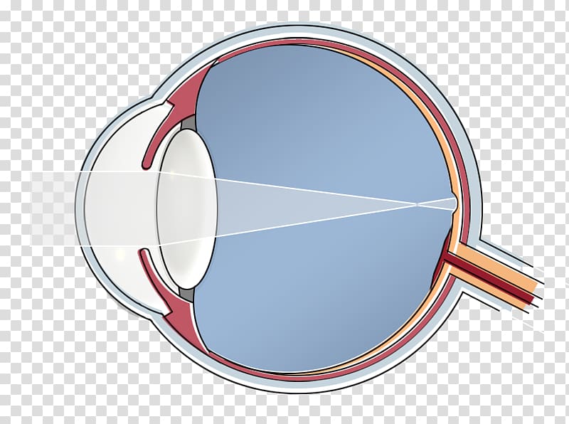 Epi-LASIK Human eye Hypermetropia Blind spot, dragen transparent background PNG clipart