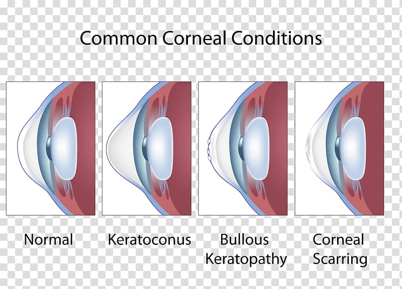 Keratoconus Cornea Symptom Eye Ophthalmology, Eye transparent background PNG clipart