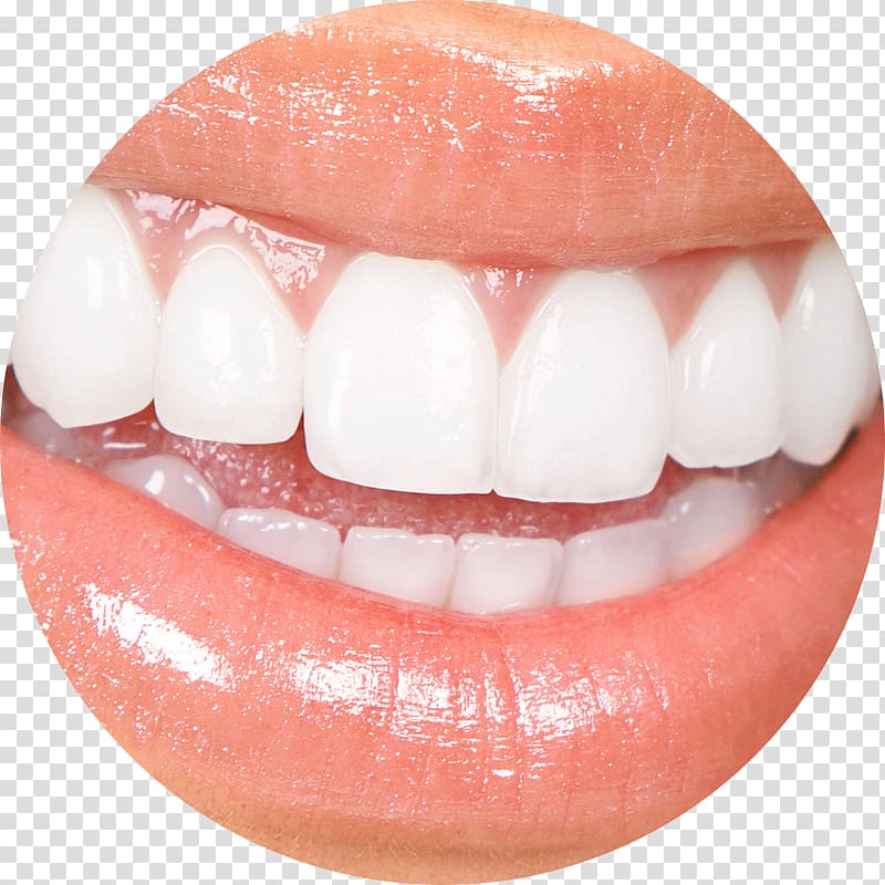 Veneer Cosmetic dentistry Tooth whitening, Tooth surgery transparent background PNG clipart