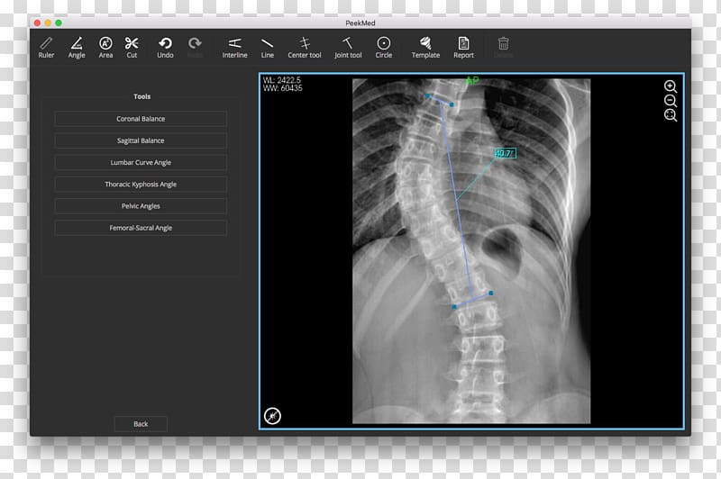 Scoliosis X-ray Vertebral column Radiography Physical therapy, Scoliosis transparent background PNG clipart