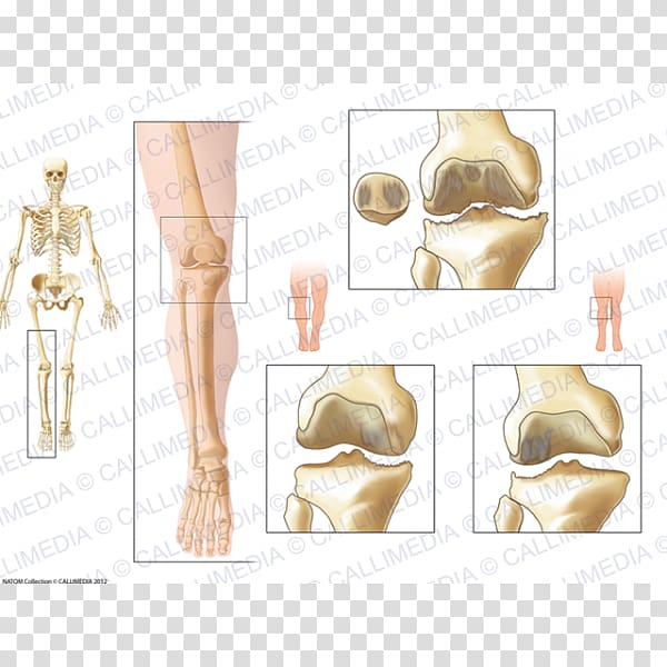 La Gonarthrose Knee osteoarthritis Knee osteoarthritis Knee arthritis, artrosis de rodilla transparent background PNG clipart