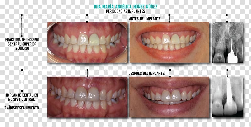 Tooth Dental implant Dentures Maxilla, Dental implant transparent background PNG clipart