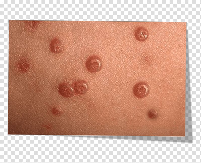 Molluscum contagiosum Skin Wheal Pediatrics Infectious disease, PENDULUM transparent background PNG clipart