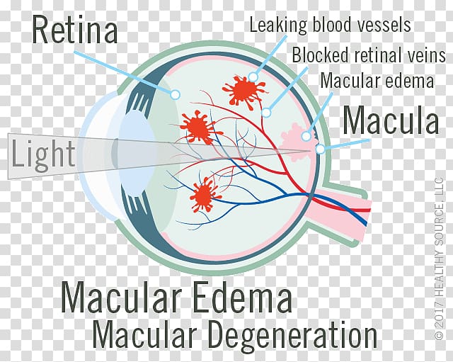 Macula of retina Macular edema Central retinal vein occlusion, Eye transparent background PNG clipart