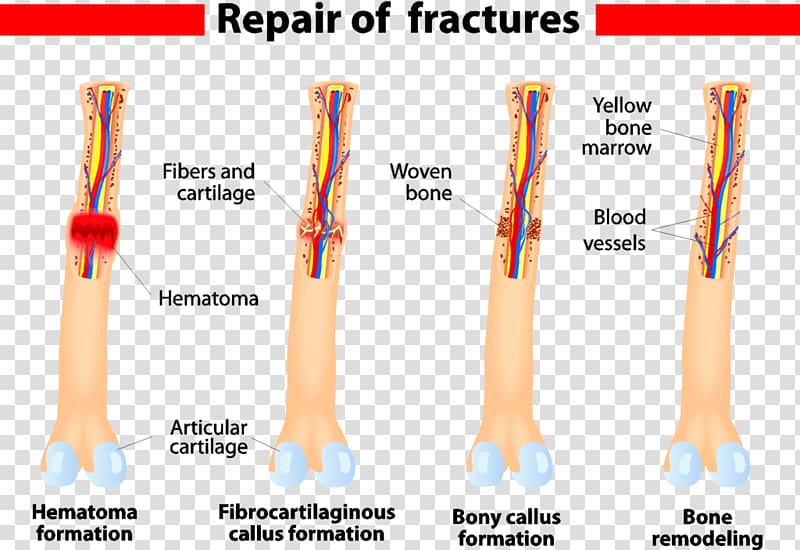 Bone healing Bone fracture Wound, Bone Fracture transparent background PNG clipart