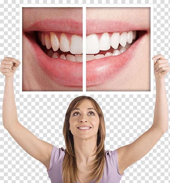 Tooth whitening Dentistry Human tooth, Tooth surgery transparent background PNG clipart